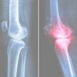 How Much Do You Know About Rheumatoid Arthritis Causes and Treatment?