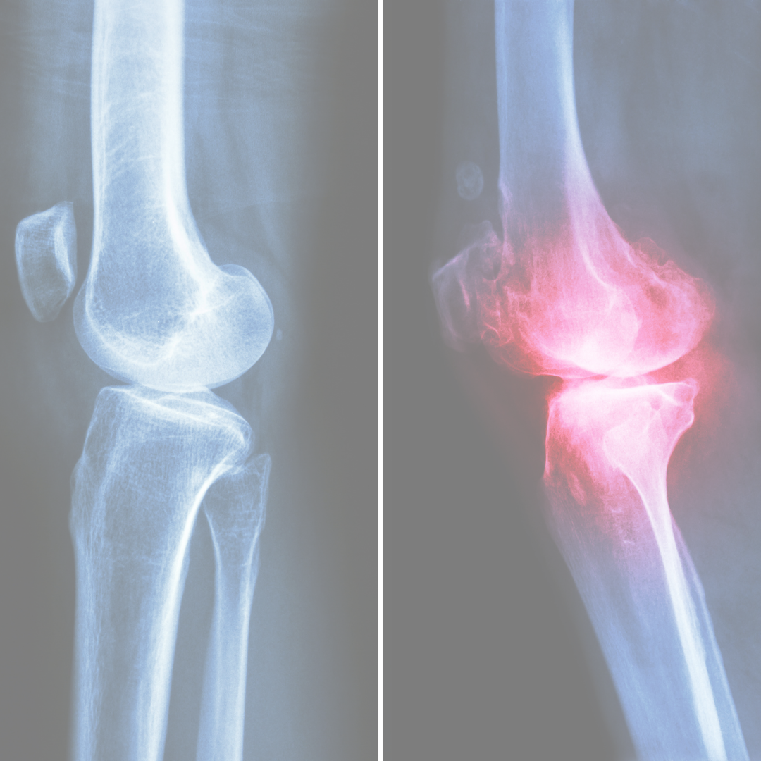 rheumatoid arthritis causes