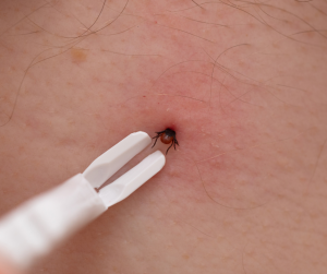 Test for Lyme Disease