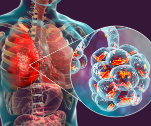 legionnaires disease - You Drug Mart legionnaires disease